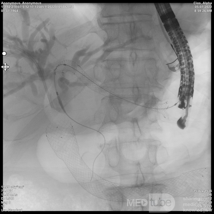 Endoskopowa hepaticogastrostomia pod kontrolą EUS [8/10]