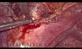 Laparoskopowa operacja przetoki pęcherzowo-macicznej
