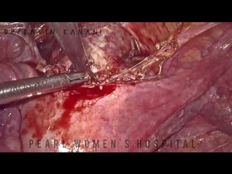 Laparoskopowa operacja przetoki pęcherzowo-macicznej