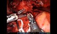Lobectomía bronquial superior derecha totalmente robótica uniportal (URATS) con reconstrucción vascular