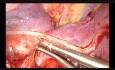 Wideotorakoskopowa lewa górna lobektomia z jednego cięcia podżebrowego