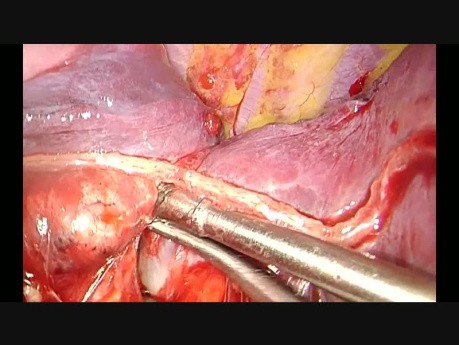 Wideotorakoskopowa lewa górna lobektomia z jednego cięcia podżebrowego