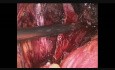 Oszczędzanie pęczka naczyniowo-nerwowego lewego - laparoskopowa radykalna prostatektomia