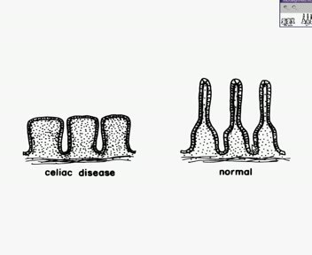 Jelito cienkie - celiakia