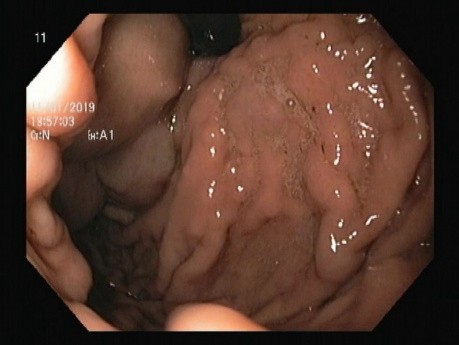 Endoskopowe zaopatrzenie żylaków dna żołądka z użyciem kleju tkankowego i opaskowanie żylaków przełyku (EVBL)