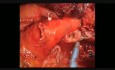 Techniczne aspekty postępowania z oskrzelem podczas lewostronnej górnej lobektomii