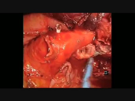 Techniczne aspekty postępowania z oskrzelem podczas lewostronnej górnej lobektomii
