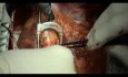 Przęsłowanie naczyń wieńcowych w znieczuleniu epiduralnym - CABG