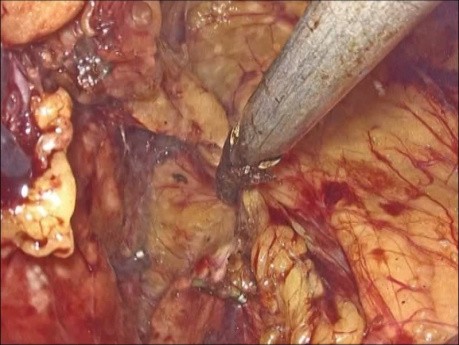 Lewostronna laparoskopowa adrenalektomia przezotrzewnowa