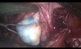 Lokalizowanie mięśniaków podczas miomektomii laparoskopowej