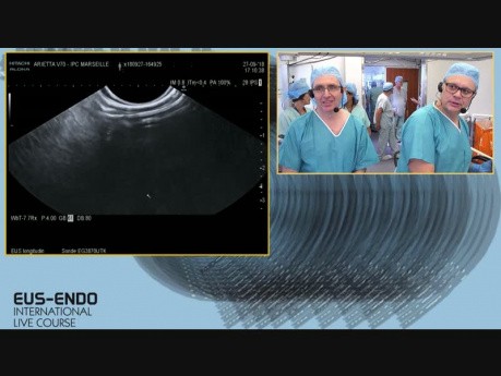 Ultrasonografia endoskopowa (EUS) z biopsją aspiracyjną cienkoigłową i +/- mikroskopią konfokalną