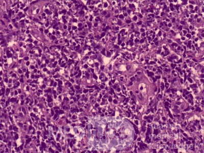 Chłoniak nieziarniczy z komórek B typu MALT  (3 z 7)