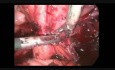 Operacja laparoskopowa guza jajnika