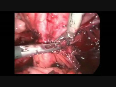 Operacja laparoskopowa guza jajnika