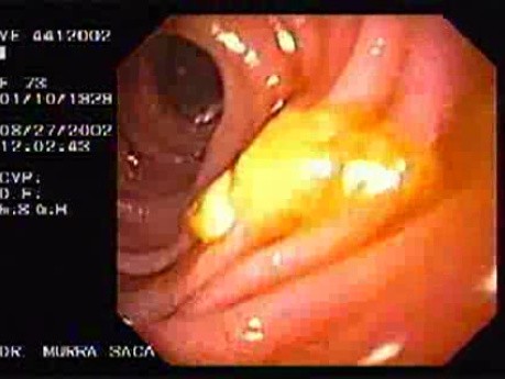 Gruczolakorak żołądka z komórkami sygnetowatymi - endoskopia (2 z 4)