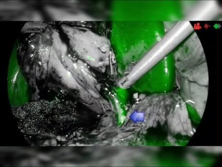 Laparoskopowa cholecystektomia fluorescencyjna z ICG. Identyfikacja wariantu przewodu żółciowego.