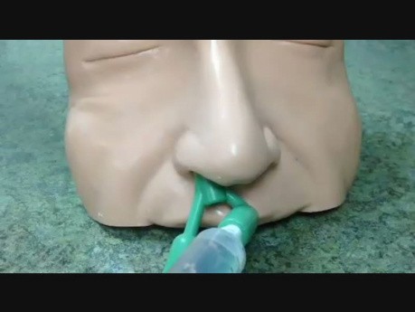 Zaopatrywanie tylnego krwawienia z nosa (tamponada tylna)
