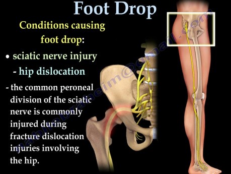 Opadanie stopy, porażenie nerwu strzałkowego