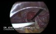 Użyteczność laparoskopii w umieszczaniu cewnika Tenckhoffa