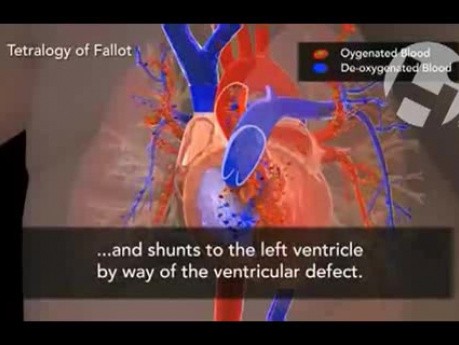 Tetralogia Fallota - wrodzona wada serca