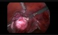 Laparoskopowa miomektomia z podwiązaniem tętnic macicznych