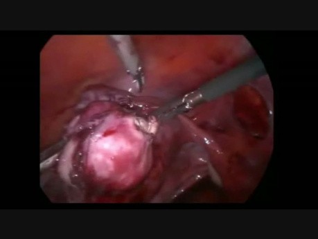 Laparoskopowa miomektomia z podwiązaniem tętnic macicznych