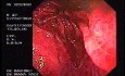 Żołądek klepsydrowaty - skurcz proksymalnej części trzonu żołądka - ocena części przedodźwiernikowej