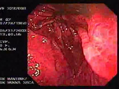 Żołądek klepsydrowaty - skurcz proksymalnej części trzonu żołądka - ocena części przedodźwiernikowej