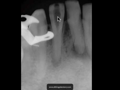 Zwapniały siekacz. Jak Odczytywać nieudane zdjęcie radiologiczne?