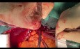 Embolektomia płucna bez użycia krążenia pozaustrojowego – nowy paradygmat w chirurgii sercowo-naczyniowej