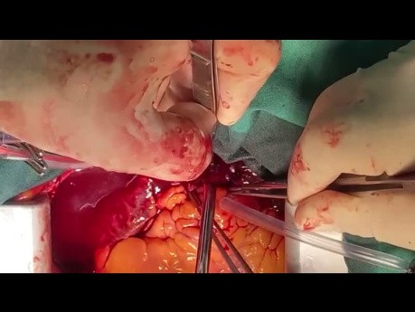 Embolektomia płucna bez użycia krążenia pozaustrojowego – nowy paradygmat w chirurgii sercowo-naczyniowej