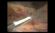 Laparoskopowa niska przednia resekcja odbytnicy (LAR) z powodu raka odbytnicy