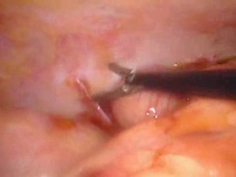 Perforacja okrężnicy z zapaleniem otrzewnej - laparoskopia (4 z 46)