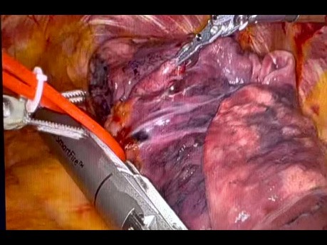 Lobektomia górnej części lewego płuca przy wykorzystaniu staplera automatycznego