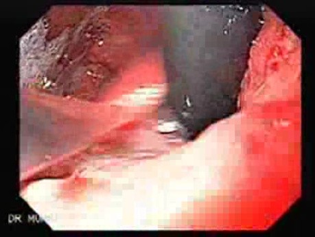 Rak włóknisty żołądka - endoskopia (4 z 47)