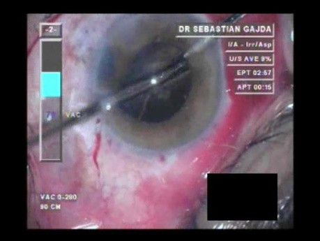 Operacja zaćmy w oku z wykonaną trabekulektomią 2