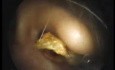 Usuwanie woskowiny usznej jako procedura ambulatoryjna przy użyciu kleszczy typu 