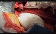Totalna resekcja przełyku z dostępu przez prawą torakotomię