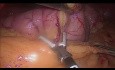 Laparoskopowa rękawowa gastrektomia