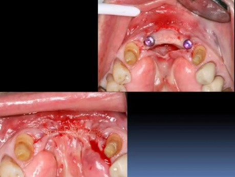 Implantomost - odbudowa protetyczna przednich zębów żuchwy