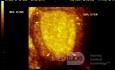 Endometrium z aktywnością wydzielniczą (obraz 3D)
