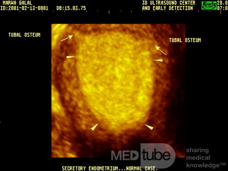 Endometrium z aktywnością wydzielniczą (obraz 3D)