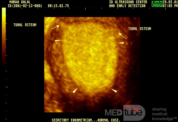 Endometrium z aktywnością wydzielniczą (obraz 3D)