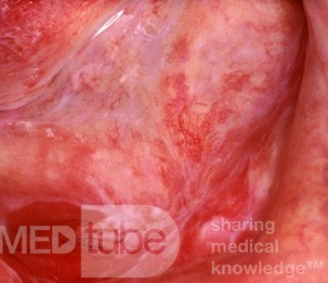 Erytroplakia (dno jamy ustnej)