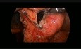 Laparoskopowa resekcja guza żołądka (GIST).