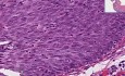 Metaplazja nabłonka płaskiego, rak - histopatologia - szyjka macicy