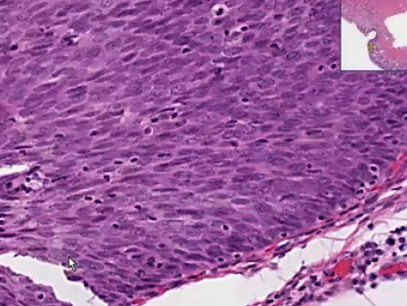 Metaplazja nabłonka płaskiego, rak - histopatologia - szyjka macicy