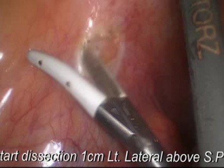 Laparoskopowa resekcja esicy z powodu raka