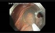 Poprzecznica - polip dywanowy - endoskopowa mukozektomia