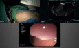 Endoskopowa cystogastrostomia martwicy ograniczonej trzustki